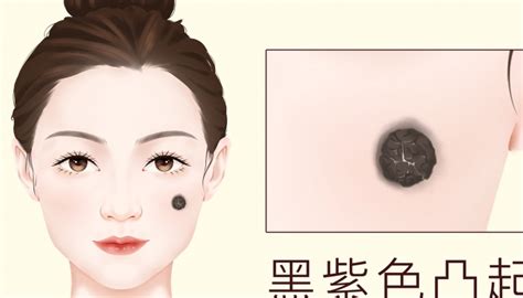 脖子黑痣|黑痣形成的原因是什么？它对人体有什么危害么？推不推荐把痣去。